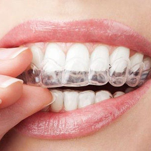 طب الأسنان-تقويم الأسنان-2